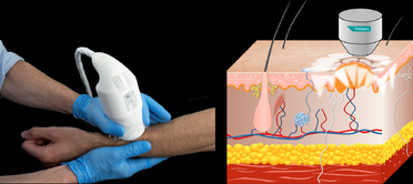 TOOsonix System ONEM BCC Clinical Trial Update image