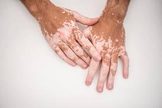 Vitiligo