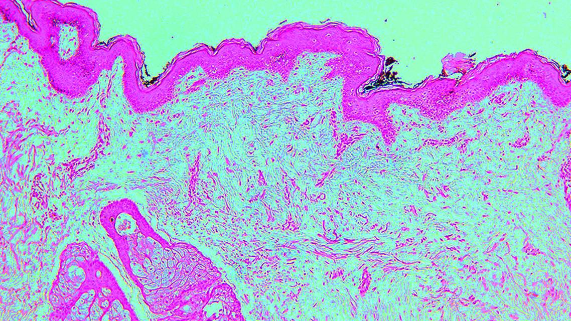 hypopigmentation