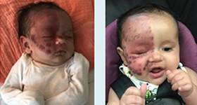 The Importance of Early Intervention forPortWine Stains in Infancy image