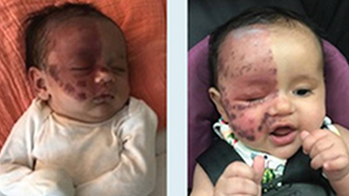 The Importance of Early Intervention forPortWine Stains in Infancy image