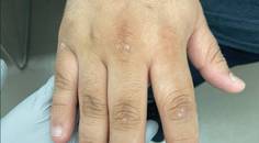 Verrucous psoriasis