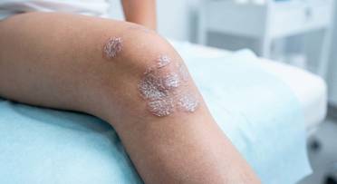 pediatric psoriasis