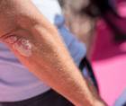 psoriasis