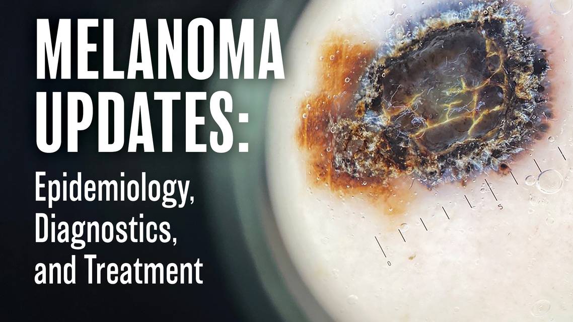 melanoma
