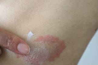 Atopic dermatitis