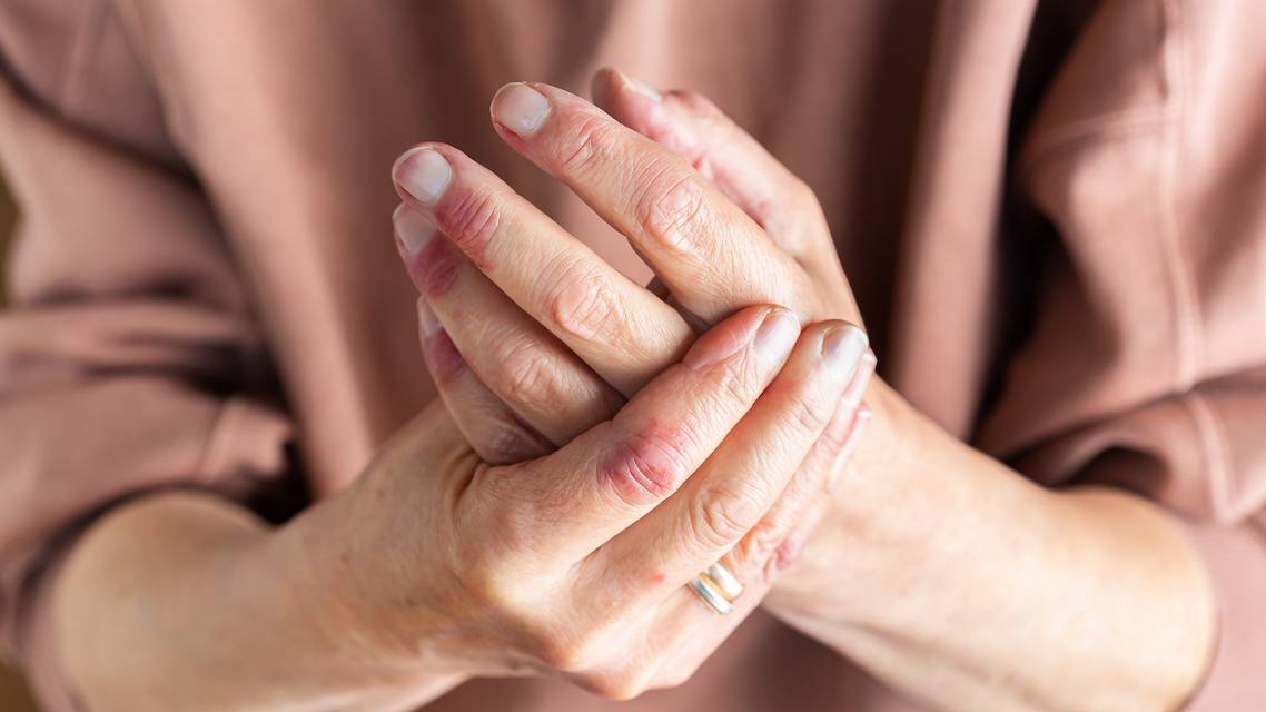 atopic dermatitis