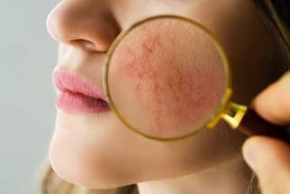 AARS Shines Light on Antibiotic Resistance During Rosacea Awareness Month image