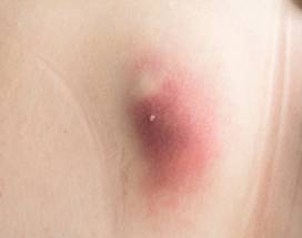 hidradenitis suppurativa