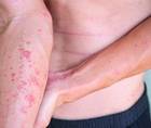 atopic derm