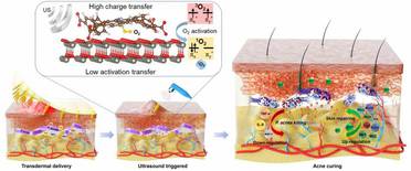 New Microneedle Patch May Treat Acne Without Antibiotics image