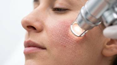 laser scar treatment