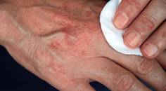 Clinical Insights and Emerging Therapeutic Options for Chronic Hand Eczema