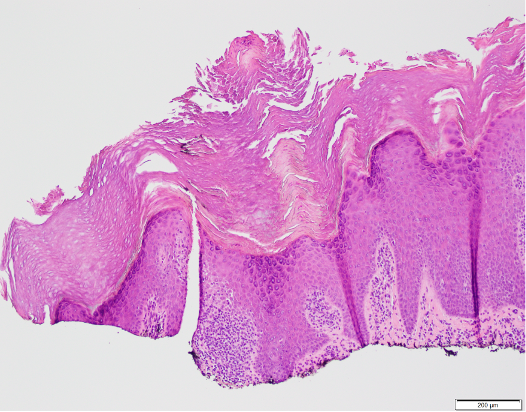 Verrucous psoriasis