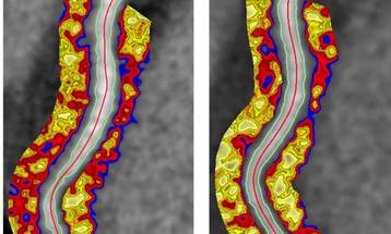 Psoriasis Therapy Linked to Reduced Coronary Inflammation image