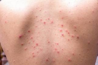 Online Extra Lets Talk About Truncal Acne image