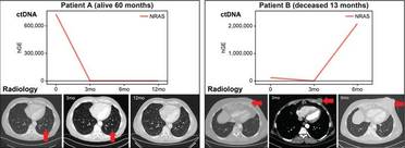 Measuring ctDNA May Lead to Alternative Treatment Options and Better Outcomes in Advanced Melanoma image