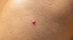 hidradenitis suppurativa
