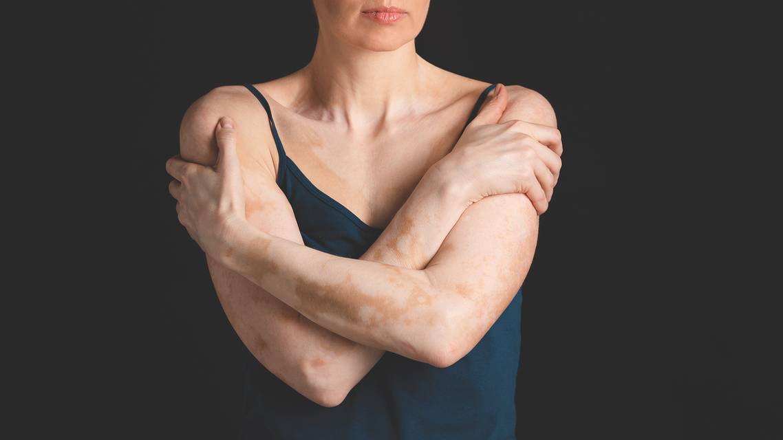 vitiligo
