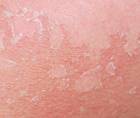 atopic dermatitis