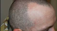 melasma