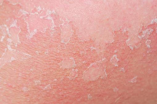 Atopic Dermatitis