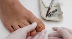 onychomychosis