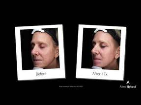 Alma Launches the Alma Hybrid and Alma TED Systems in Canada image