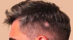 alopecia
