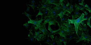 Scientists Identify Genomic Cause and Potential Treatment for Disabling Pansclerotic Morphea image