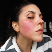 NRS Survey Persistent Facial Redness is the Most Common and Bothersome Sign of Rosacea image