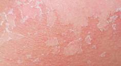 atopic dermatitis