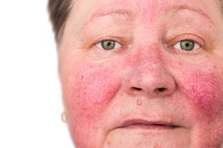 rosacea