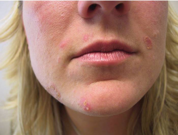 Impetigo
