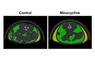 Longterm Systemic Antibiotic Use for Teen Acne May Promote Fat Accumulation image