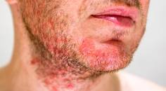 facial eczema