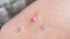 hidradenitis suppurativa