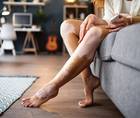 vitiligo