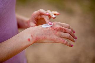 Chronic Hand Eczema