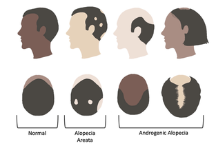 A Clinicians Guide to Alopecia Diagnosis Treatment and Prevention image