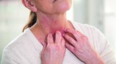 atopic dermatitis