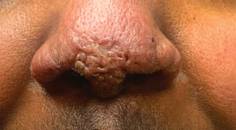 sarcoidosis
