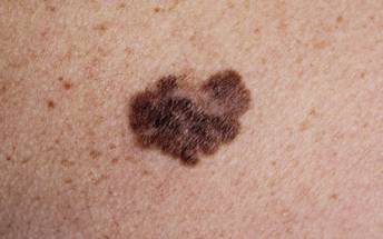 New Biomarkers May Help Advance Melanoma Detection image