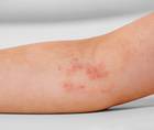 Atopic Dermatitis