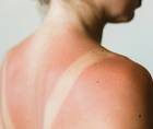 aftersun care