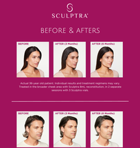 Galdermas Sculptra Now FDA Approved for Cheeks image