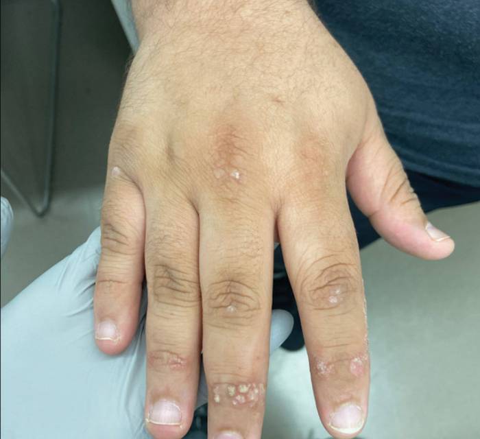 Verrucous psoriasis