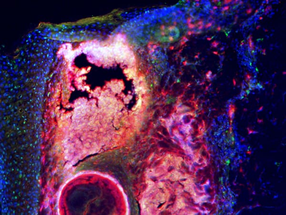 Acne Breakthrough Fat Cells in the Skin May Help Fight Acne image