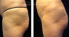 HIFEM Plus Biostimulator for Rounder Buttocks image