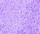 papules